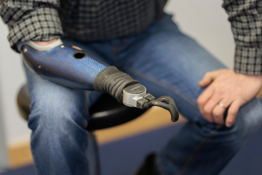 Prosthetic arm Prosthetic arm